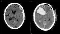 Prophylactic anticoagulation in traumatic subdural hematoma - Scientific Reports