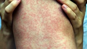 Measles Outbreak Causes Concern At Helmond School