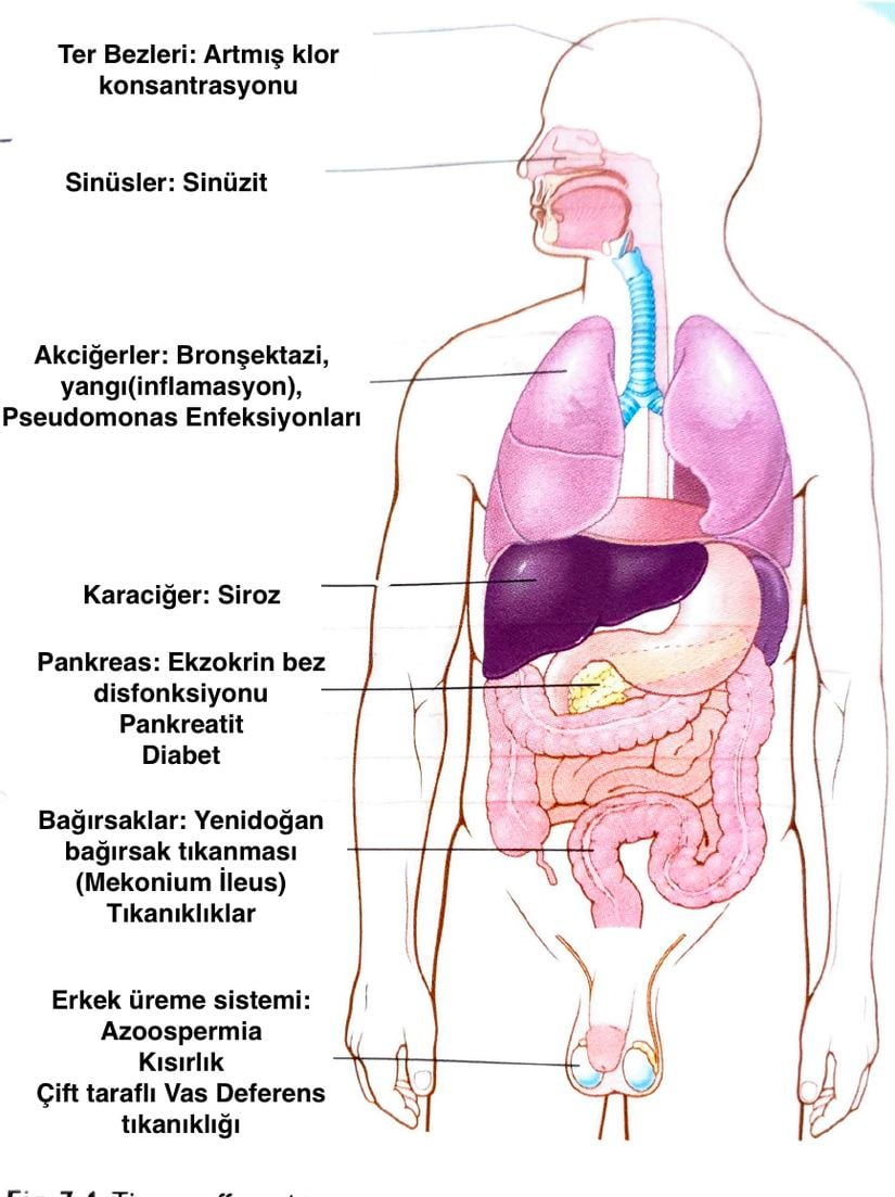 Kistik Fibrozisin Belirtileri