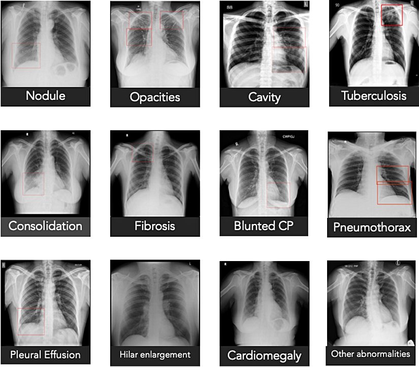 Qure.ai qXR sisteminin tespit edebileceği akciğer anomalileri
