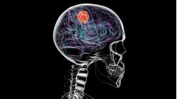 Beyin Kanseri, Kafatasının Bazı Kısımlarını Eritebilir!