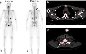 New AI Framework Revolutionizes Detection Of Breast Cancer Bone Metastases