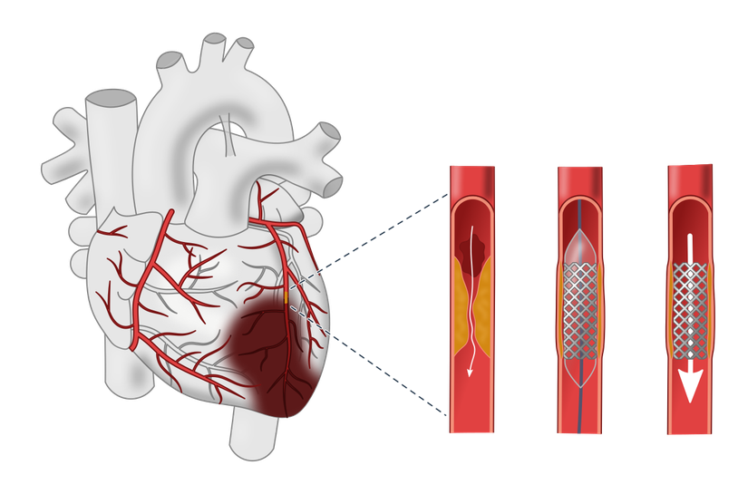 Arteri genişletmek için takılan stent.