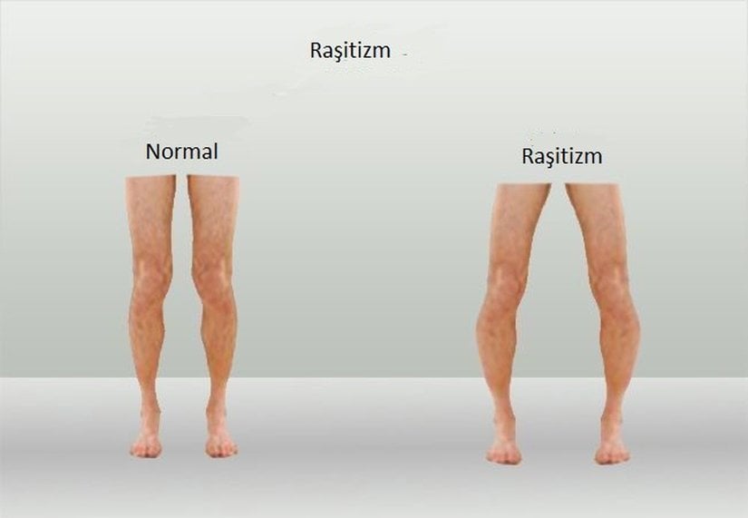 D vitamini eksikliğinden kaynaklanan raşitizm hastalığında bacak normal halinden daha çarpık bir hal alır.
