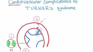 New Study Reveals Cardiovascular Risks In Girls With Turner Syndrome