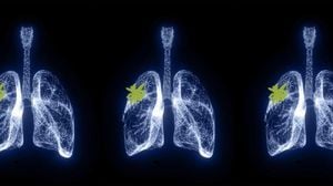 Breakthrough Urine Test Detects Early Lung Cancer Signs