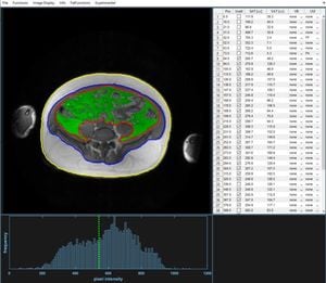 New MRI Tool Enhances Abdominal Fat Measurement In Obesity