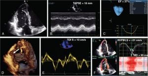 Autostrain RV Technique Revolutionizes Cardiac Monitoring During Chemotherapy