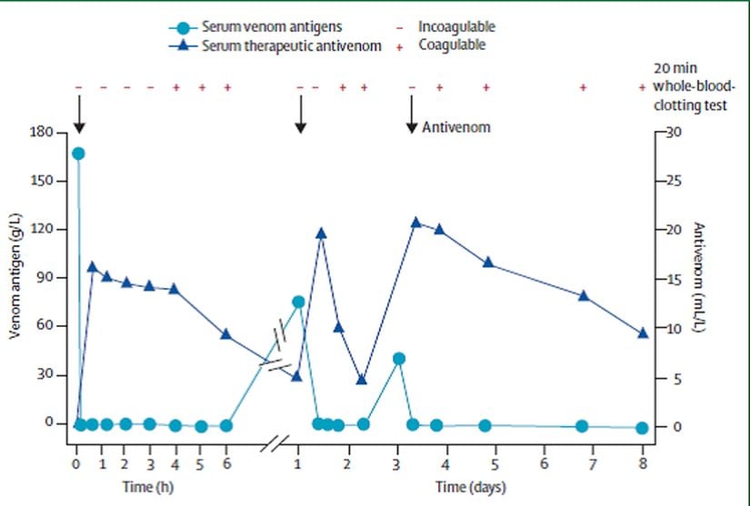 Şekilde Malayan çukur engerek tarafından zehirlenmiş ve pıhtılaşmasının düzelmesi için üç doz panzehire ihtiyacı olan bir hastanın pıhtılaşma bozukluğu durumu gösterilmektedir.