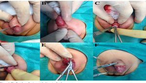 New Study Compares Safety Of Circumcision Techniques