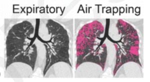 Study Finds Air Trapping Key To Understanding Idiopathic Pulmonary Fibrosis