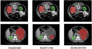 AI Models Enhance Renal Cancer Diagnostics With CT Imaging