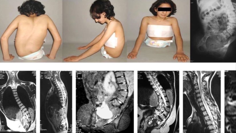 Kaudal Regresyon Sendromu Nedir? Belirtileri ve Tedavi Seçenekleri Nelerdir?