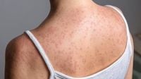 Measles outbreak spreads to new state as cases in US hit record high