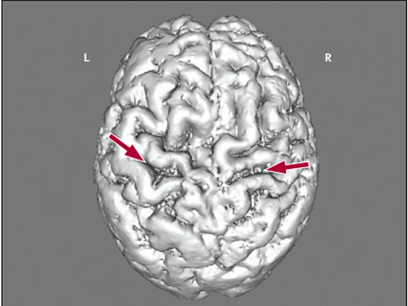 Oklar, özellikle motor şeritleri olmak üzere bitişik girusun göreceli atrofisi ile birlikte gözle görülür şekilde genişlemiş ön merkez sulkusunu göstermektedir. Burada görüldüğü gibi makroskopik atrofi, tipik ALS'li hastalarda nadirdir, ancak baskın olarak üst motor nöron rahatsızlığı olan primer lateral sklerozu olanlarda daha sık görülür. Bu rakam, daha genel olarak ALS'ye özgü olduğu varsayılan bir kortikomotonöronal sürecin geç aşamasını vurgulamaktadır.