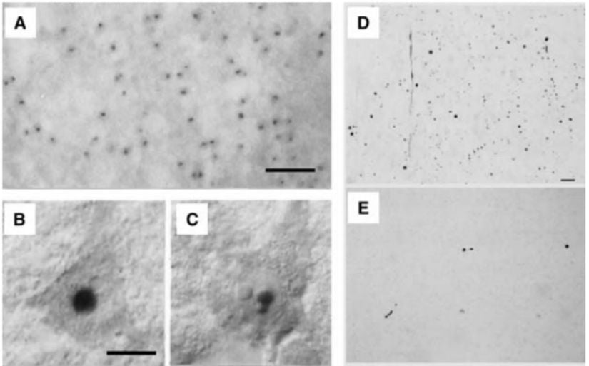 Huntington hastalığı, mutant Huntingtin proteini içeren protein depoları ile karakterizedir.