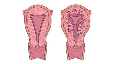 Adenomyozis