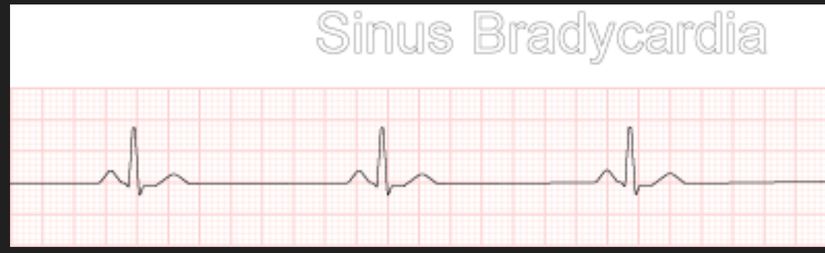 Kalp Yavaş Ritim