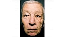 Tek Yönlü Dermatoheliyoz: Yüzünün Tek Tarafı, Güneş Nedeniyle Daha Fazla "Yaşlanan" Sürücü!