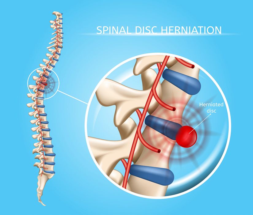 Disk hernisi, çekirdeğin bir kısmı halkadaki bir çatlaktan geçtiğinde oluşur ve eğer, halk arasında fıtık olarak tabir edilen bu herni bir siniri sıkıştırırsa kişide semptomlar ortaya çıkacaktır.