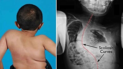 Cam Kemik Hastalığı