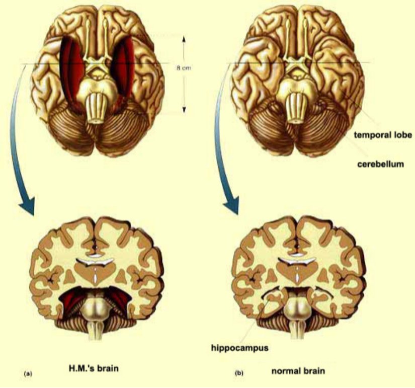 Görsel, retrograd amnezi üzerine yapılan çalışmalarda sıkça incelenen H.M. vakasını temsil etmektedir. Sol tarafta (a) H.M.'nin beyni görülmektedir; temporal loblarının büyük bir kısmı ve hipokampus cerrahi olarak çıkarılmıştır. Sağ tarafta (b) ise sağlıklı bir beynin yapısı gösterilmektedir. Hipokampusun çıkarılması, H.M.’nin yeni anılar oluşturma yetisini kaybetmesine ve retrograd amnezi semptomları yaşamasına neden olmuştur. Bu vaka, hipokampusun hafıza oluşumundaki kritik rolünü anlamamıza önemli katkılar sağlamıştır.
