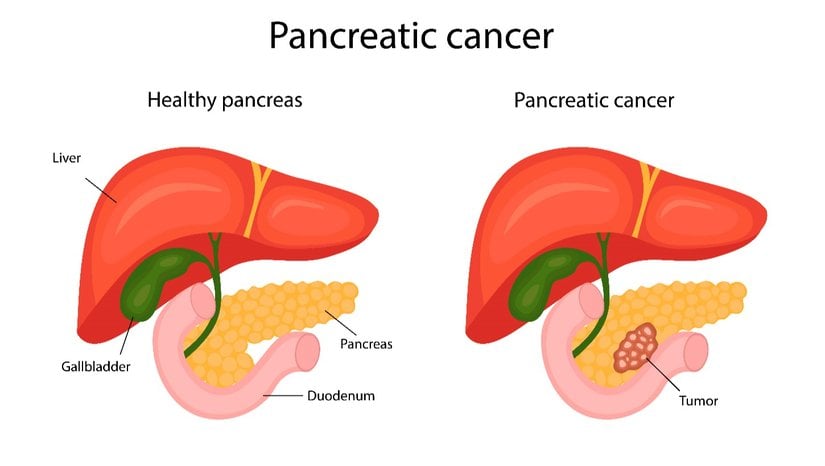 Pankreas Kanseri Nedir? Belirtileri Nelerdir? Tedavi Seçenekleri Nelerdir?
