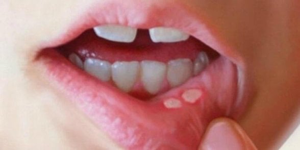 Aft, genellikle 1 veya 2 tane oluyor daha fazlası da olabilir ama çok nadir