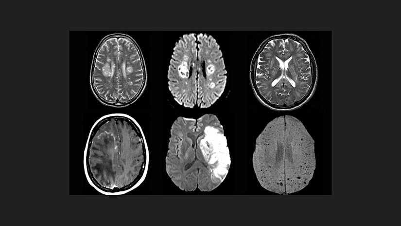 Beyin MR  görüntüsü