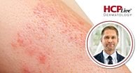 Management of Cutaneous Adverse Events in Oncodermatology, With Drew Kuraitis, MD, PhD | HCPLive