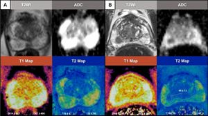 Revolutionizing Prostate Cancer Diagnostics With Innovative Imaging