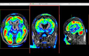 Novel MRI-PET Fusion Technique Enhances Medical Imaging Accuracy