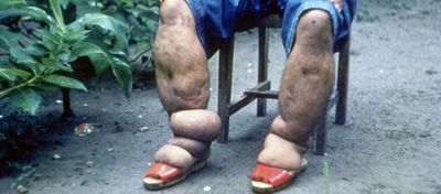 Fil Hastalığı (Elephantiasis)