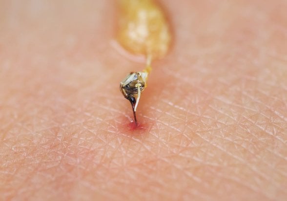 Sokan arının insan derisi üzerindeki iğnesi.