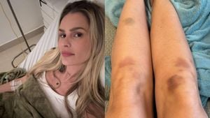 Model Yasmin Brunet Shares Her Lipedema Struggles