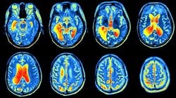 Pozitron Emisyon Tomografisi (PET) Nedir? PET Taraması ile Görüntüleme Nasıl Yapılıyor? Hastalar Nasıl Bir Süreçten Geçiyor?