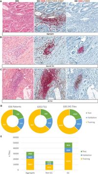 Automated classification of tertiary lymphoid structures in colorectal cancer using TLS-PAT artificial intelligence tool - Scientific Reports