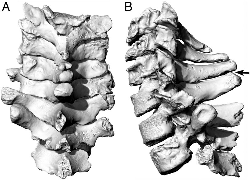 La Chapelle aux Saints Neandertalinin omurgalarındaki dejenerasyon.