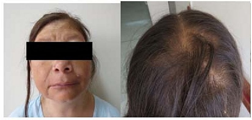 Sheehan Sendromlu hastada saç dökülmesi ve yüz ödemi görülmekte.