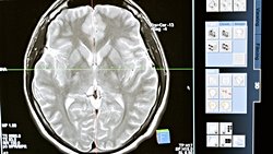 Spinoserebellar Ataksi Tip 2 Hastalarının Beyinlerinde Poliglutamin ve Transaktivasyona Duyarlı DNA Bağlayıcı Protein 43'ün Paralel Görünümü ve Tamamlayıcı Subselüler Lokalizasyonu