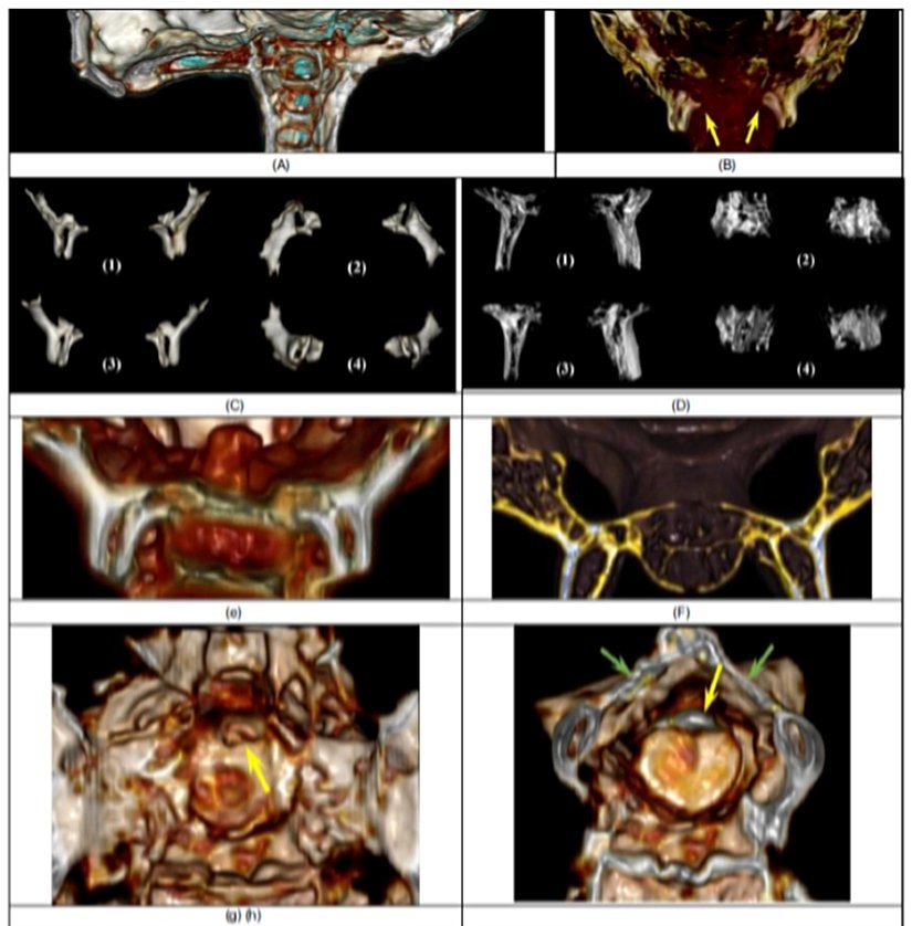 Şekil 16. (a) Servikal omurları ve bunların kafatasına eklemlenmelerini gösteren sahte renkli sagital görünüm. (b) Oksipital kondillerin önalt  görünümü. Sarı oklarla gösterilen konumlandırma ve durdurma özelliğidir. (c) Josephina ve Lama'nın (d) oksipital kondilleri, çeşitli  açılardan görülüyor. (1)  Alt görünüm. (2) Üstün. (3) Arka. (4) Ön. Aşağıdakileri gösteren koronal kesit: (e) Josephina'nın oksipital kondilleri ile eklemlenen  servikal omurlar; (f) lamanın oksipital kondilleri gösteren ilgili bölümü. (gi) Servikal omurların enine kesitleri. (g) Birinci servikal omurun  üst yüzeyi. (h) Temel ranyumun alt tarafının hemen altındaki bölüm. Sarı oklar bir tür kordonu (doku?) gösteriyor, yeşil oklar ise servikal  omurları birbirine bağlayan açılı bir kemiğin izlerini gösteriyor.
