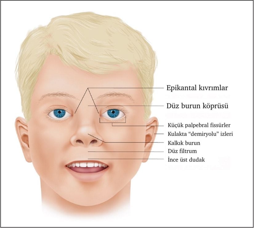 Fetal Alkol Spektrum Bozuklukları ile ilişkili yüz özellikleri