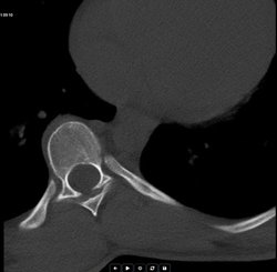 Skolyoz yüz üstü yatmakla ilişkili olabilir mi?