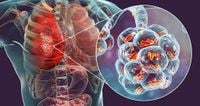 Legionnaires’ disease cluster in New York City causes 3 deaths, sickens over 80 people. What is it, and how do you get it?