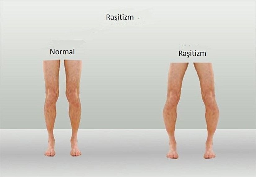 D vitamini eksikliğinden kaynaklanan raşitizm hastalığında bacak normal halinden daha çarpık bir hal alır.