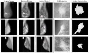 Quantum-Optimized Hybrid Approach Revolutionizes Breast Cancer Detection