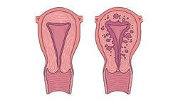 Adenomyozis
