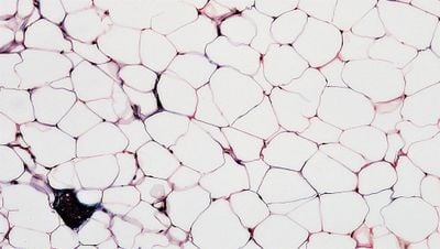 Kanser Hücrelerini Açlıktan Öldürmenin Yolunu Bulmuş Olabiliriz! Yeni Bir Potansiyel Hücresel Tedavi: Adipoz Manipülasyon Transplantasyonu (AMP)