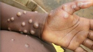 California Reports First Case Of New Mpox Strain