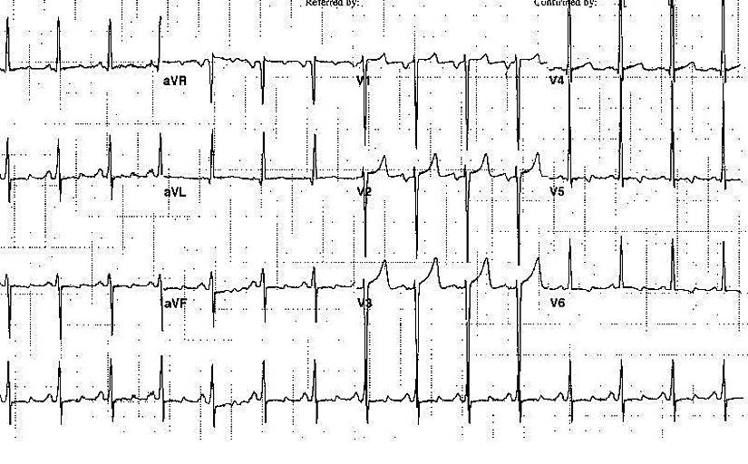 Uzun süredir kontrolsüz hipertansiyon öyküsü olan 47 yaşındaki bir erkeğe ait elektrokardiyogram (EKG). Bu görüntü sol atriyal genişlemeyi ve sol ventrikül hipertrofisini göstermektedir.